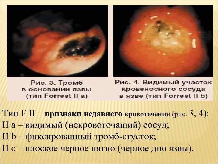 Тип F II – признаки недавнего кровотечения (рис. 3, 4): II а – видимый