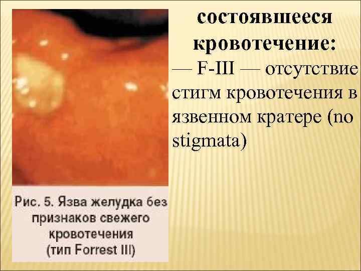 состоявшееся кровотечение: — F-III — отсутствие стигм кровотечения в язвенном кратере (no stigmata) 