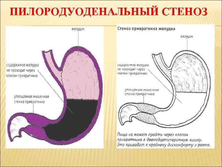 ПИЛОРОДУОДЕНАЛЬНЫЙ СТЕНОЗ 