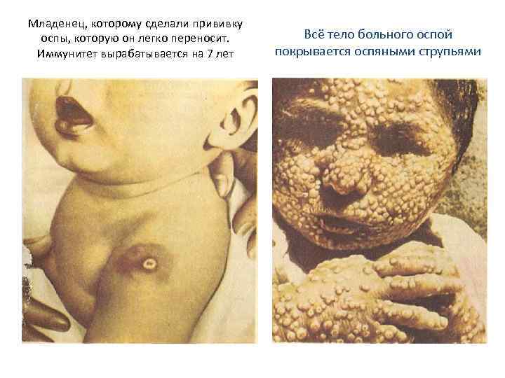 Младенец, которому сделали прививку оспы, которую он легко переносит. Иммунитет вырабатывается на 7 лет