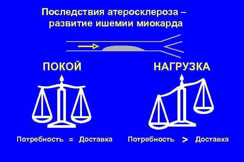 Последствия атеросклероза – развитие ишемии миокарда ПОКОЙ Потребность = Доставка НАГРУЗКА Потребность > Доставка