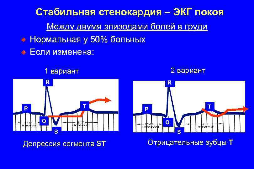 Экг в покое. Стабильная стенокардия ЭКГ признаки. Приступ стенокардии на ЭКГ. ИБС стенокардия напряжения ЭКГ. ЭКГ при стабильной стенокардии напряжения.