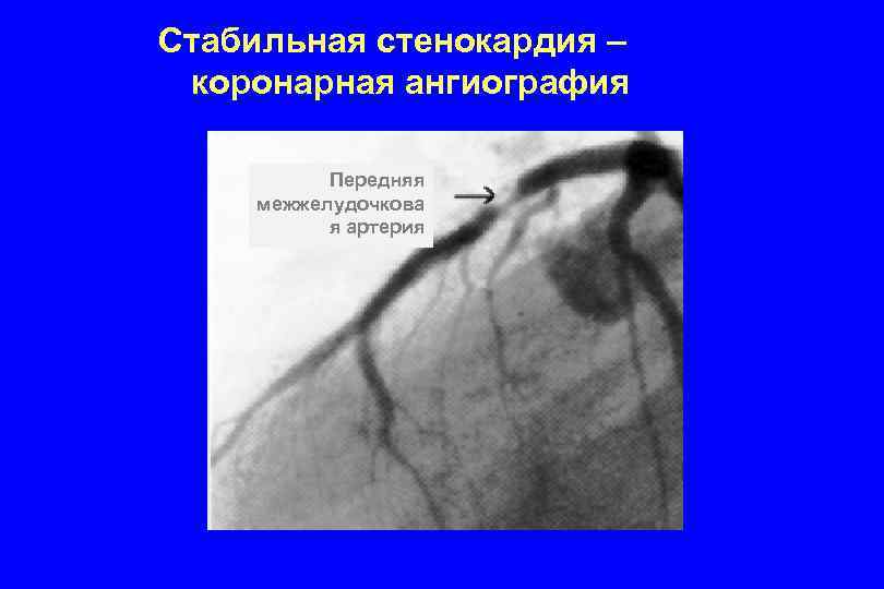 Стабильная стенокардия – коронарная ангиография Передняя межжелудочкова я артерия 