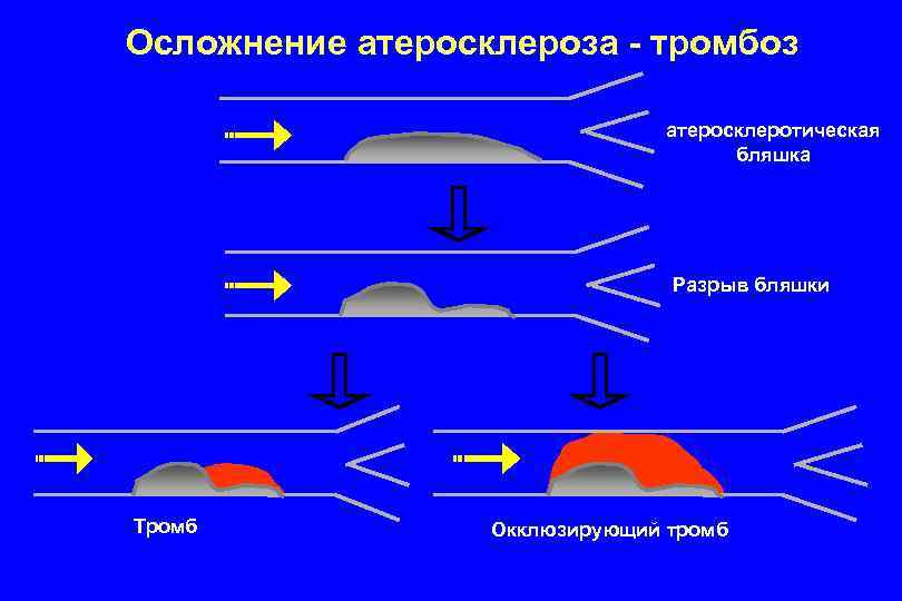 Осложнение атеросклероза - тромбоз атеросклеротическая бляшка Разрыв бляшки Тромб Окклюзирующий тромб 