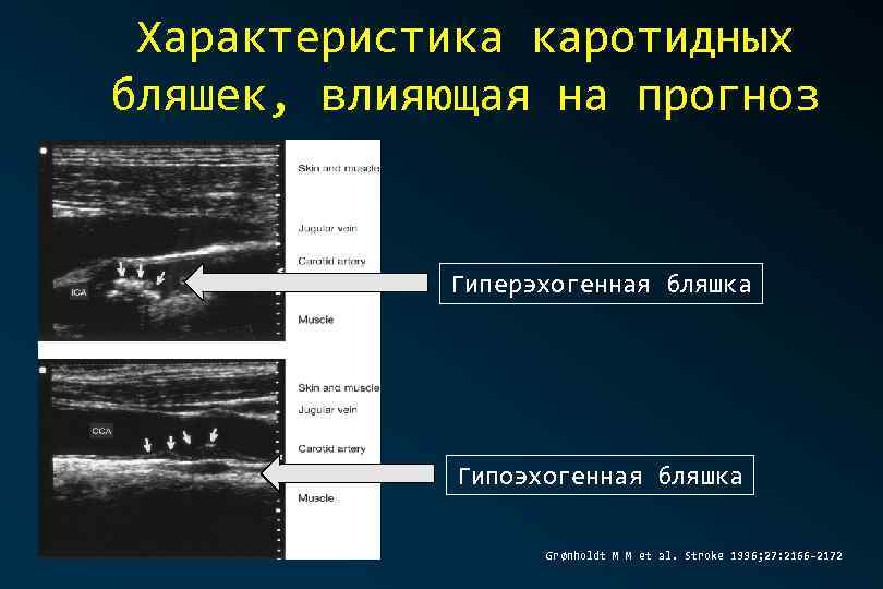 Характеристика каротидных бляшек, влияющая на прогноз Гиперэхогенная бляшка Гипоэхогенная бляшка Grønholdt M M et