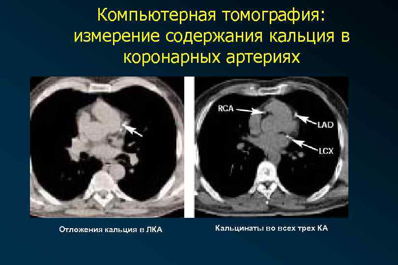 Компьютерная томография: измерение содержания кальция в коронарных артериях Отложения кальция в ЛКА Кальцинаты во