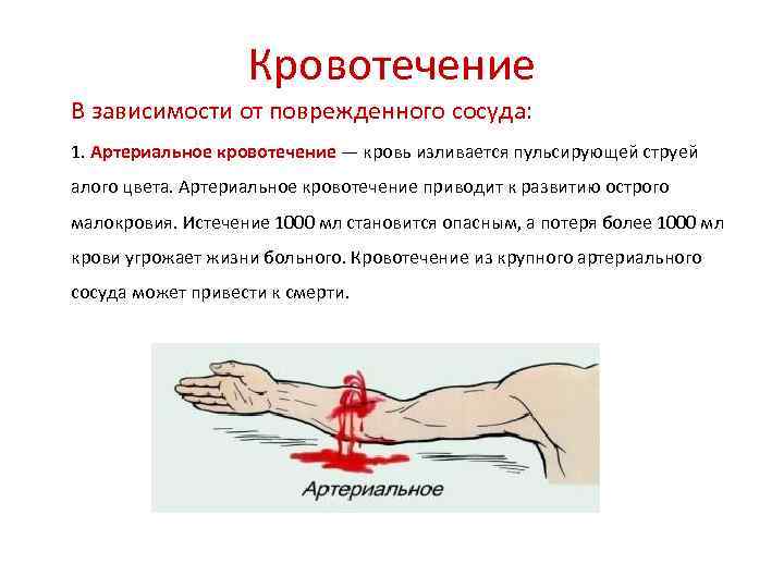 Кровотечение В зависимости от поврежденного сосуда: 1. Артериальное кровотечение — кровь изливается пульсирующей струей