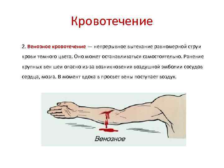 Кровотечение 2. Венозное кровотечение — непрерывное вытекание равномерной струи крови темного цвета. Оно может