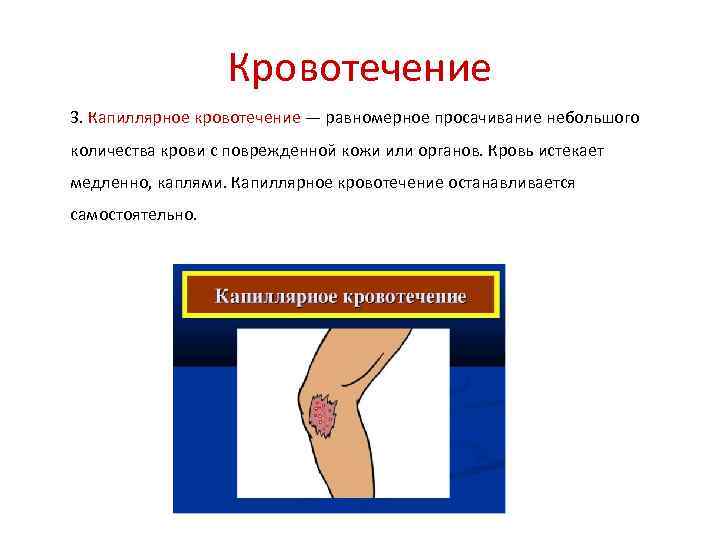 Кровотечение 3. Капиллярное кровотечение — равномерное просачивание небольшого количества крови с поврежденной кожи или