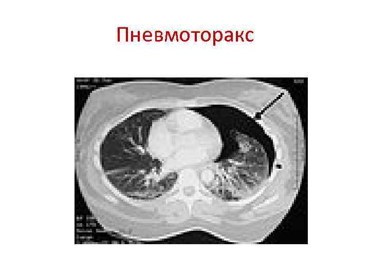 Пневмоторакс 
