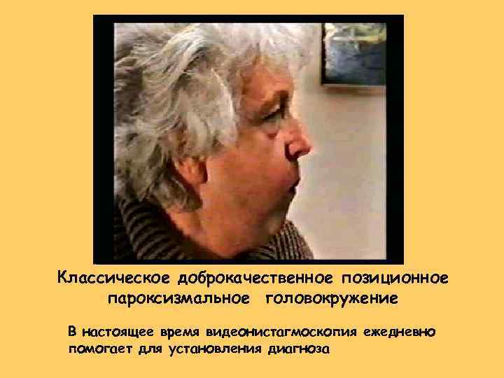 Классическое доброкачественное позиционное пароксизмальное головокружение В настоящее время видеонистагмоскопия ежедневно помогает для установления диагноза