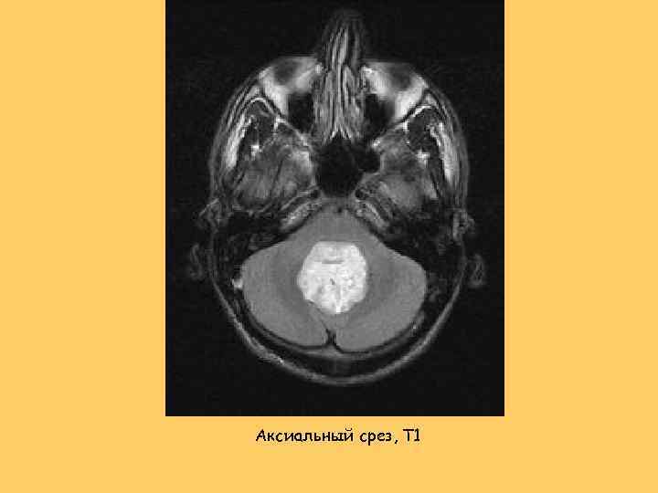 Aксиальный срез, T 1 