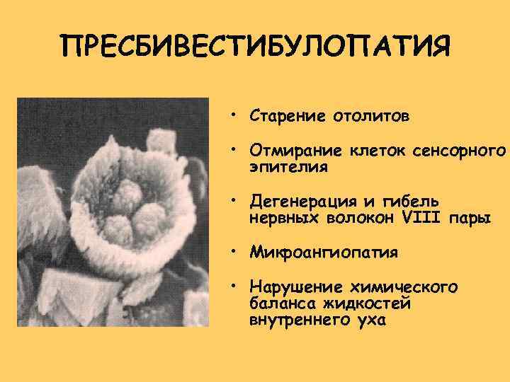 ПРЕСБИВЕСТИБУЛОПАТИЯ • Старение отолитов • Отмирание клеток сенсорного эпителия • Дегенерация и гибель нервных