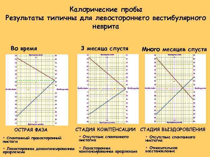 Калорические пробы Результаты типичны для левостороннего вестибулярного неврита Во время кризиса ОСТРАЯ ФАЗА 3