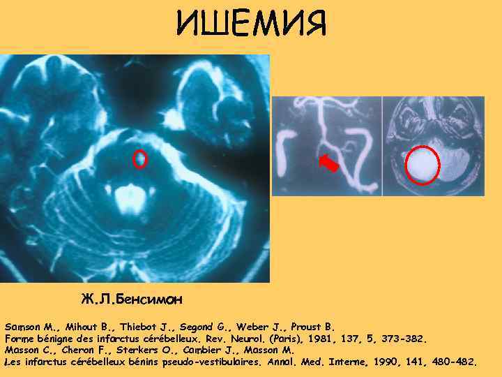 ИШЕМИЯ Ж. Л. Бенсимон Samson M. , Mihout B. , Thiebot J. , Segond