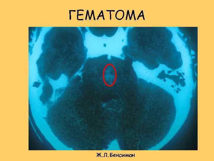 ГЕМАТОМА Ж. Л. Бенсимон 