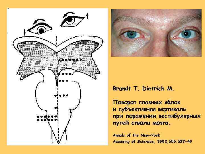 Brandt T, Dietrich M, Поворот глазных яблок и субъективная вертикаль при поражении вестибулярных путей