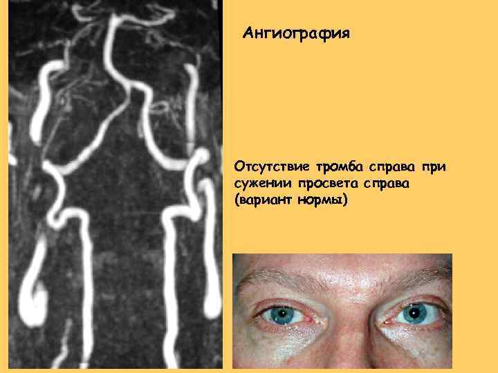 Aнгиография Отсутствие тромба справа при сужении просвета справа (вариант нормы) 