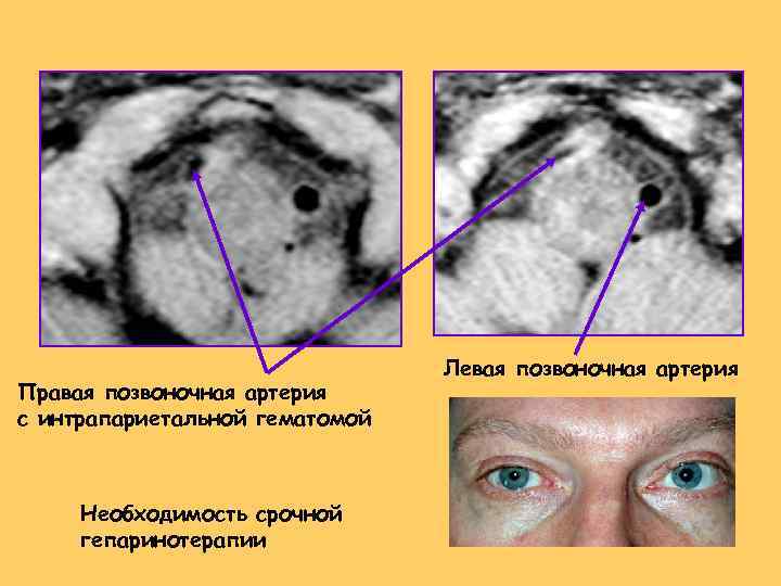 Правая позвоночная артерия с интрапариетальной гематомой Необходимость срочной гепаринотерапии Левая позвоночная артерия 