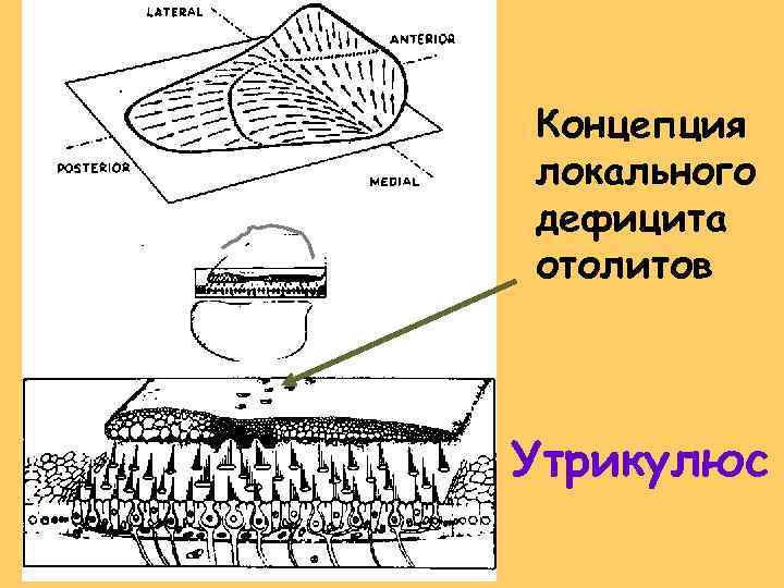 Концепция локального дефицита отолитов Утрикулюс 