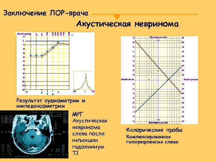 Заключение ЛОР-врача Акустическая невринома Результат аудиометрии и импедансометрии МРГ Акустическая невринома слева после инъекции