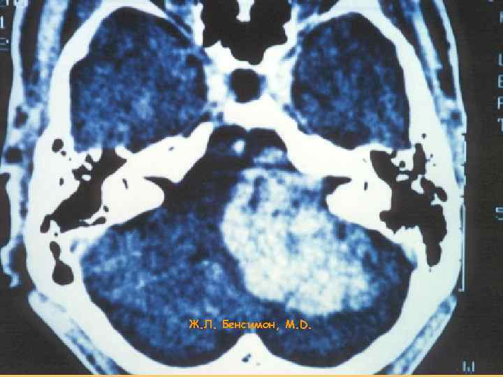 Ж. Л. Бенсимон, М. D. 