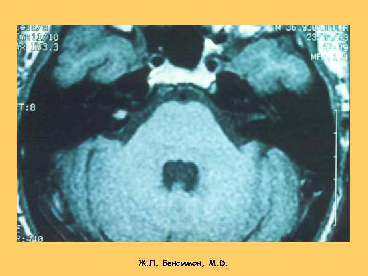 Ж. Л. Бенсимон, М. D. 