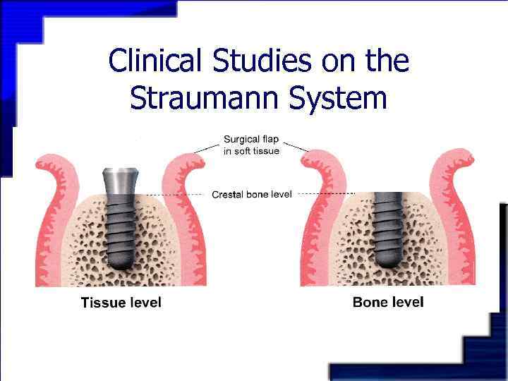 Clinical Studies on the Straumann System 