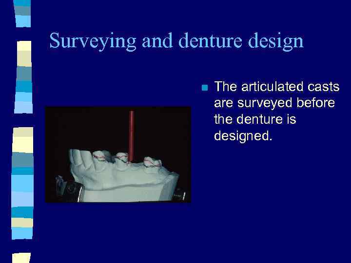 Surveying and denture design n The articulated casts are surveyed before the denture is