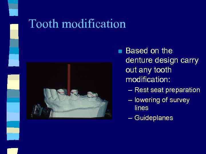Tooth modification n Based on the denture design carry out any tooth modification: –