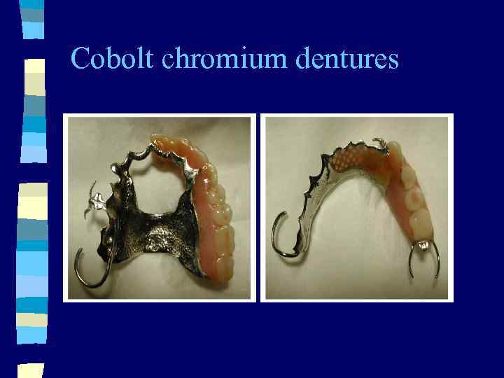 Cobolt chromium dentures 