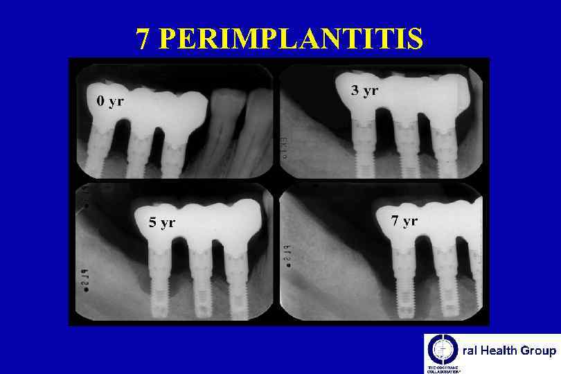 7 PERIMPLANTITIS 