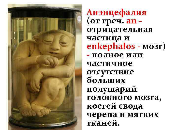  • Анэнцефалия (от греч. an отрицательная частица и enkephalos - мозг) - полное