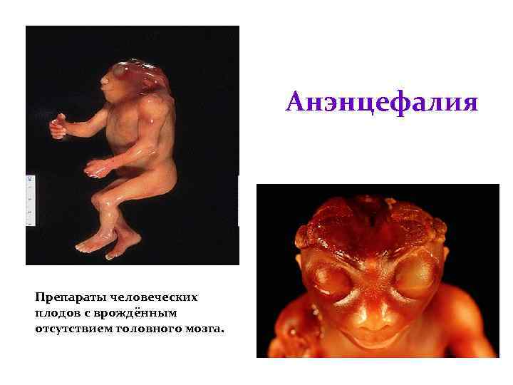 Анэнцефалия Препараты человеческих плодов с врождённым отсутствием головного мозга. 