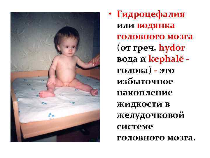  • Гидроцефалия или водянка головного мозга (от греч. hydōr вода и kephalē голова)