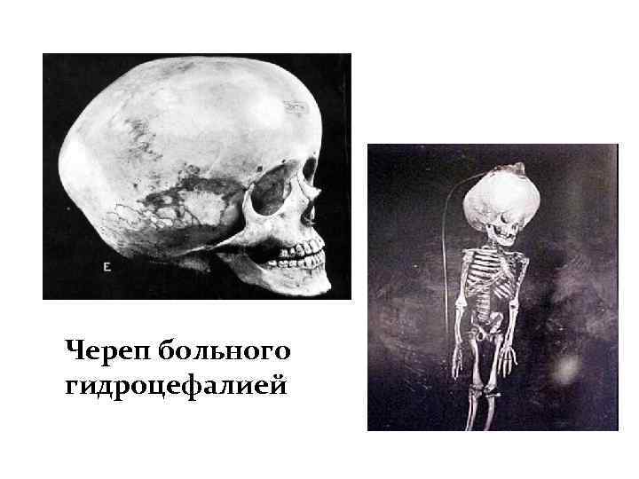 Череп больного гидроцефалией 