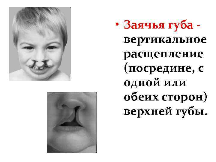  • Заячья губа вертикальное расщепление (посредине, с одной или обеих сторон) верхней губы.