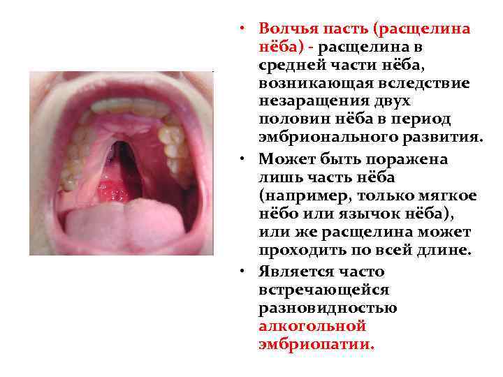  • Волчья пасть (расщелина нёба) - расщелина в средней части нёба, возникающая вследствие