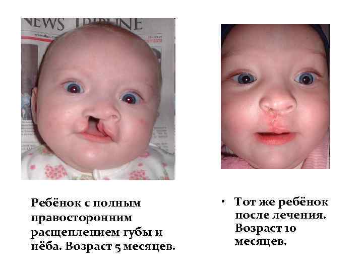 Ребёнок с полным правосторонним расщеплением губы и нёба. Возраст 5 месяцев. • Тот же