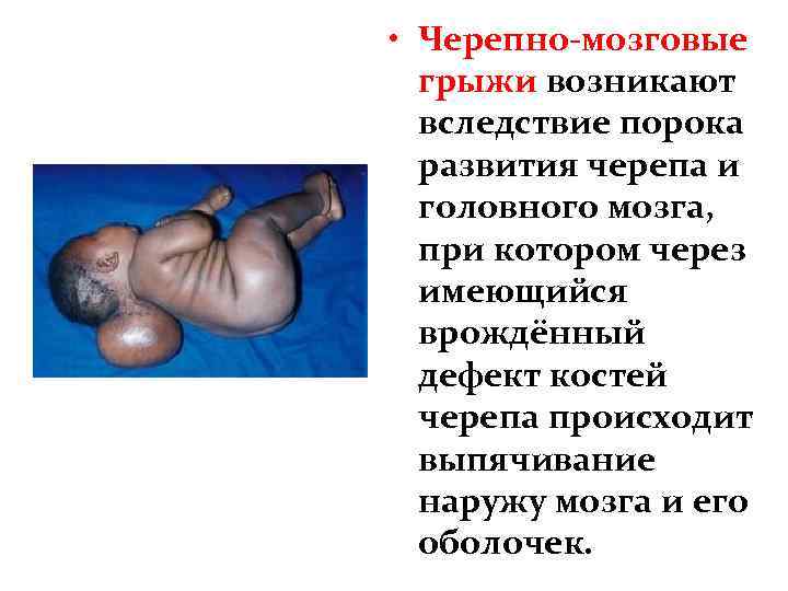  • Черепно-мозговые грыжи возникают вследствие порока развития черепа и головного мозга, при котором