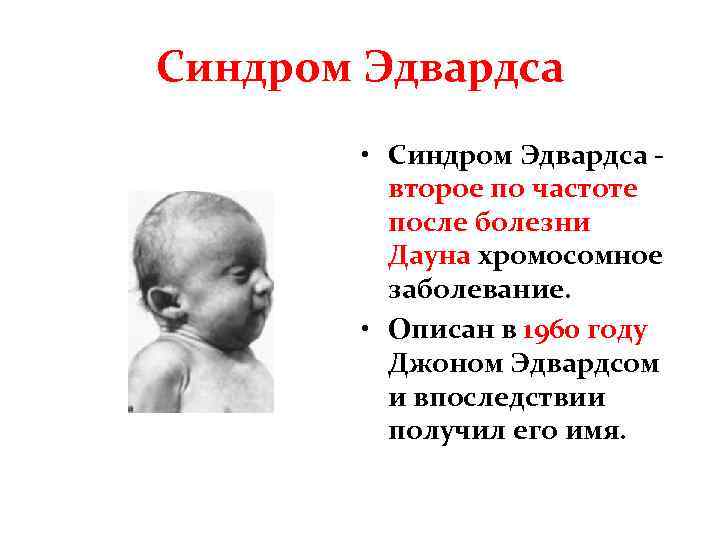 Синдром Эдвардса • Синдром Эдвардса второе по частоте после болезни Дауна хромосомное заболевание. •