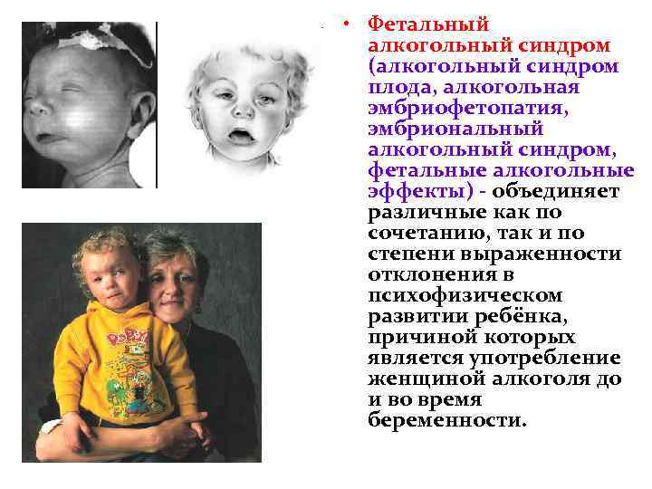  • Фетальный алкогольный синдром (алкогольный синдром плода, алкогольная эмбриофетопатия, эмбриональный алкогольный синдром, фетальные