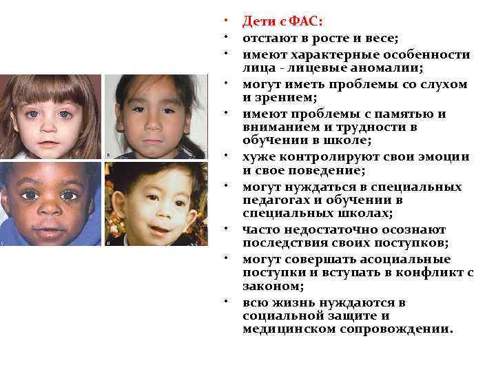  • • • Дети с ФАС: отстают в росте и весе; имеют характерные