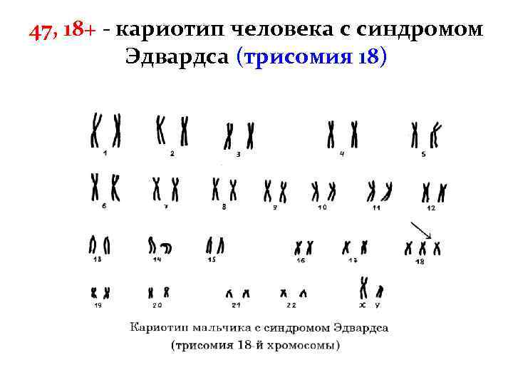47, 18+ - кариотип человека с синдромом Эдвардса (трисомия 18) 