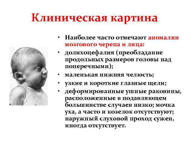 Клиническая картина • Наиболее часто отмечают аномалии мозгового черепа и лица: • долихоцефалия (преобладание