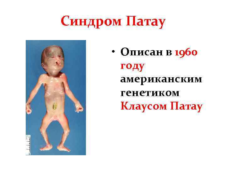 Синдром Патау • Описан в 1960 году американским генетиком Клаусом Патау 