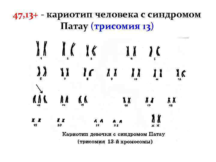 Синдром патау хромосомы