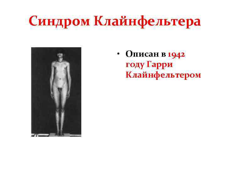 Синдром Клайнфельтера • Описан в 1942 году Гарри Клайнфельтером 