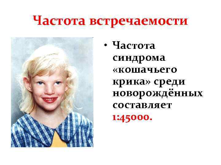 Частота встречаемости • Частота синдрома «кошачьего крика» среди новорождённых составляет 1: 45000. 