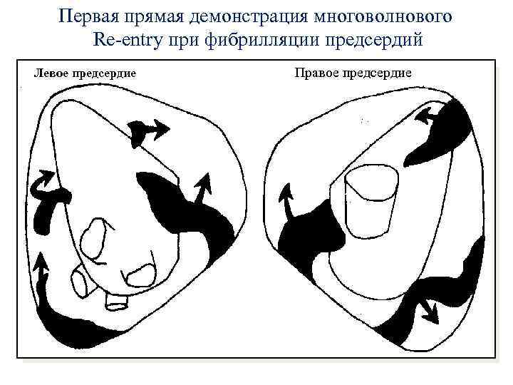 Первая прямая демонстрация многоволнового Re-entry при фибрилляции предсердий Левое предсердие Правое предсердие 